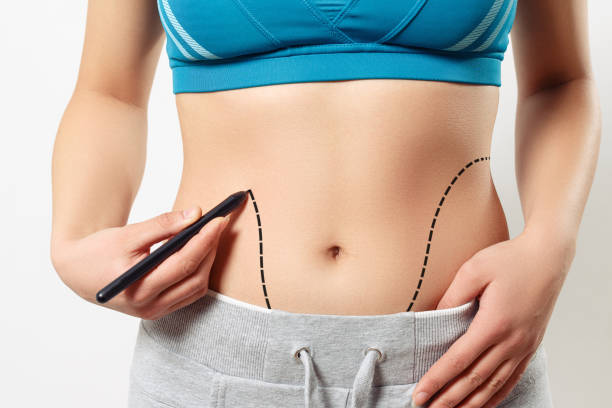 Experience Advanced Laser Liposuction in Riyadh for Quick Fat Loss