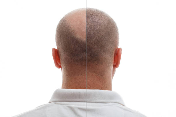 The Secret to a Fuller Head of Hair: Hair Restoration in Riyadh