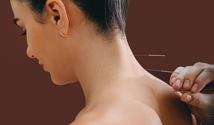 Can Acupuncture Treat Migraines Triggered by Neck Pain or Cervical Issues