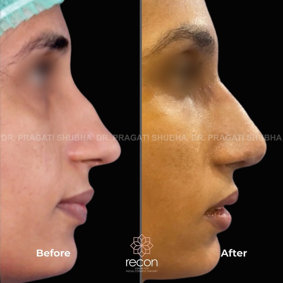 Best Rhinoplasty Surgeon in Gurgaon | Nose Reshaping & Rhinoplasty -ReconAesthetics