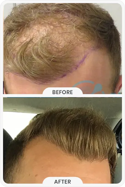 Why Is FUE the Best Hair Transplant in Turkey?