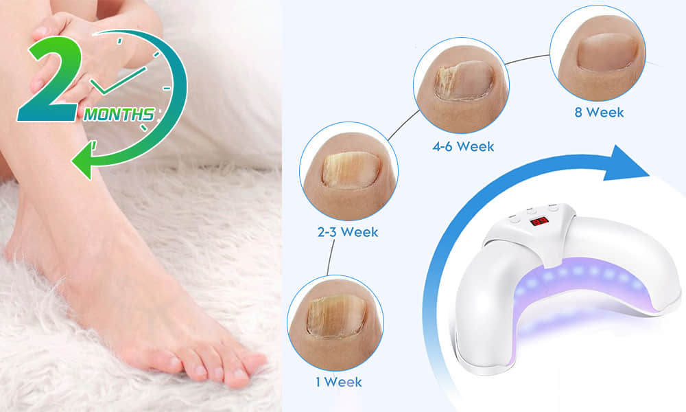 FungaBeam Reviews – [Verified Review] Eliminate Nail Fungus Fast & Safely!
