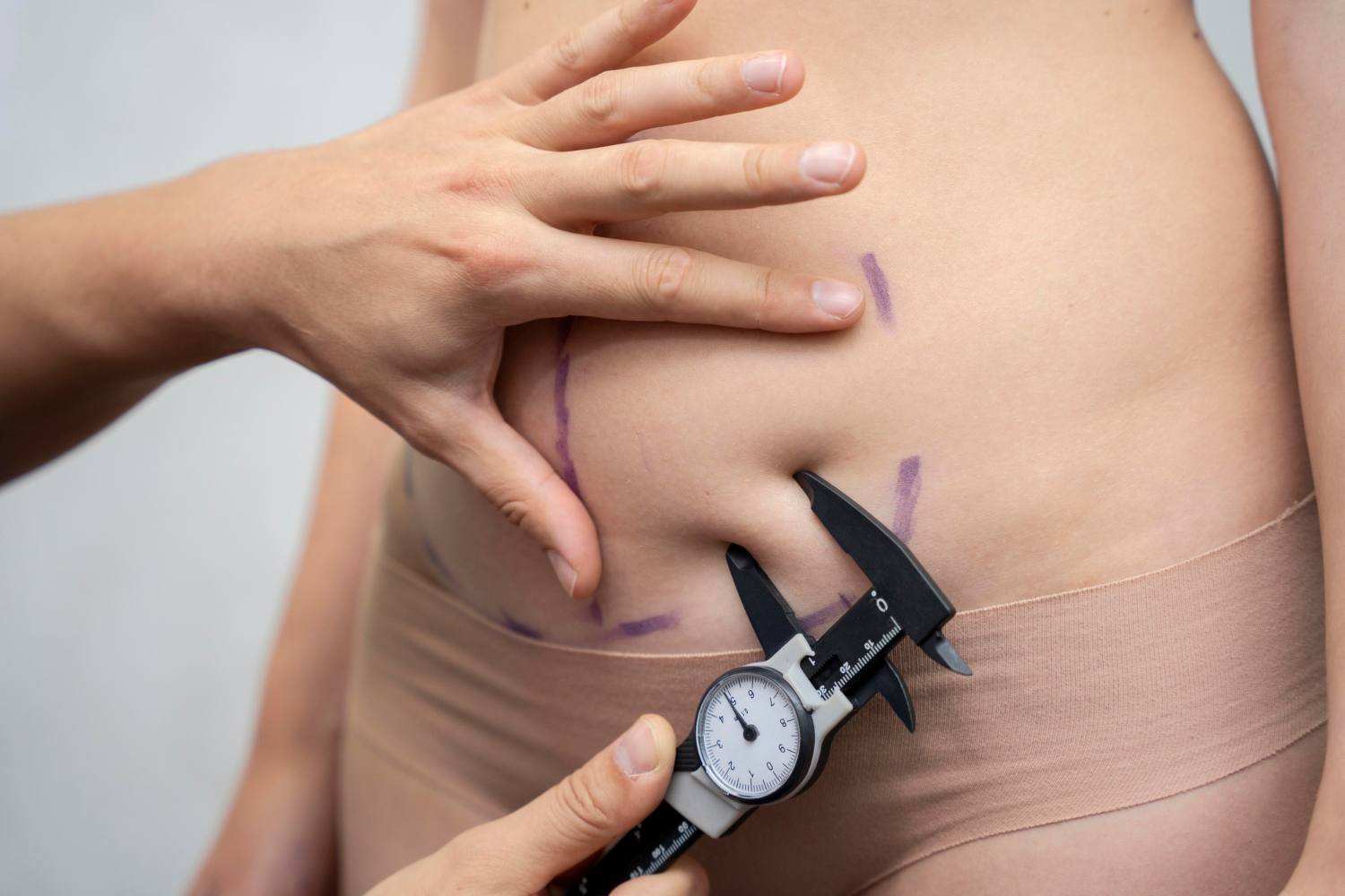 Combining Liposuction, BBL, and Tummy Tucks for Full Body Transformation