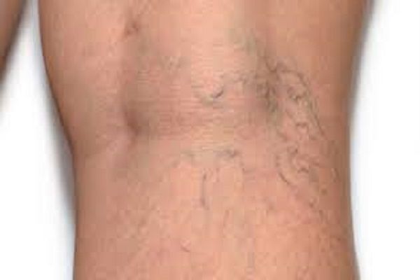 Does Combining Treatments Offer Better Results for Stubborn Veins?
