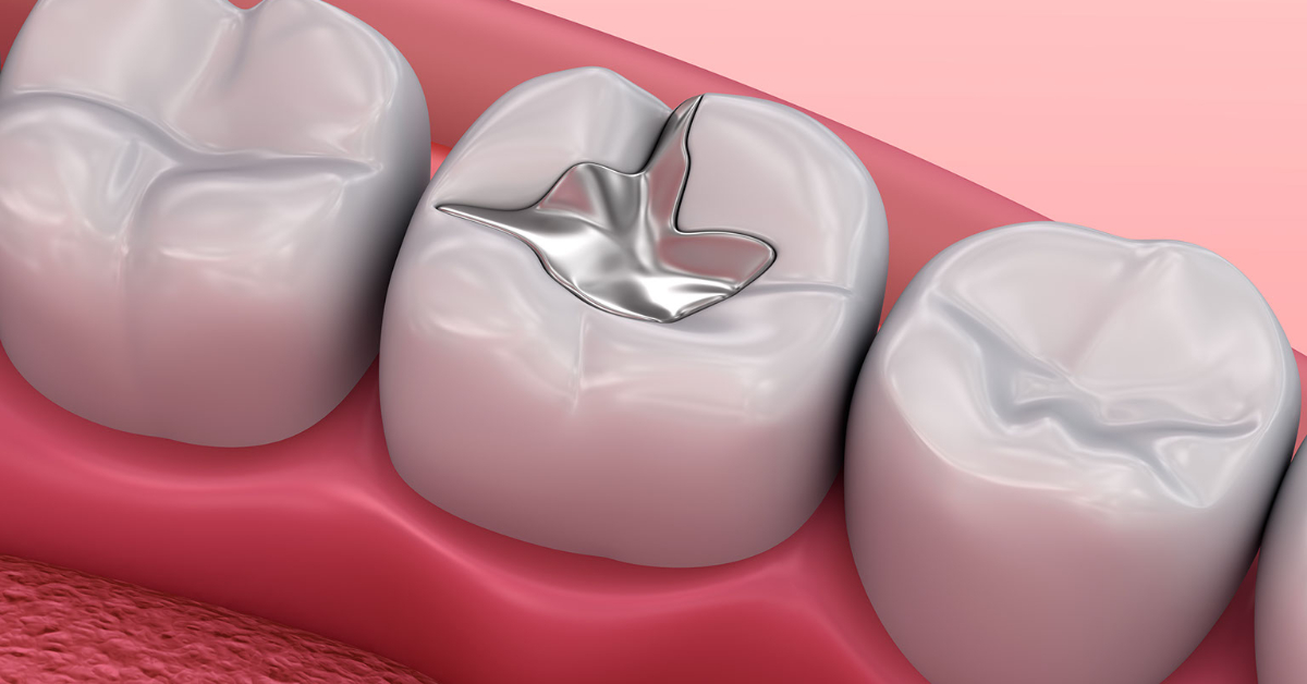 How to Care for Dental Fillings: Tips for Longevity
