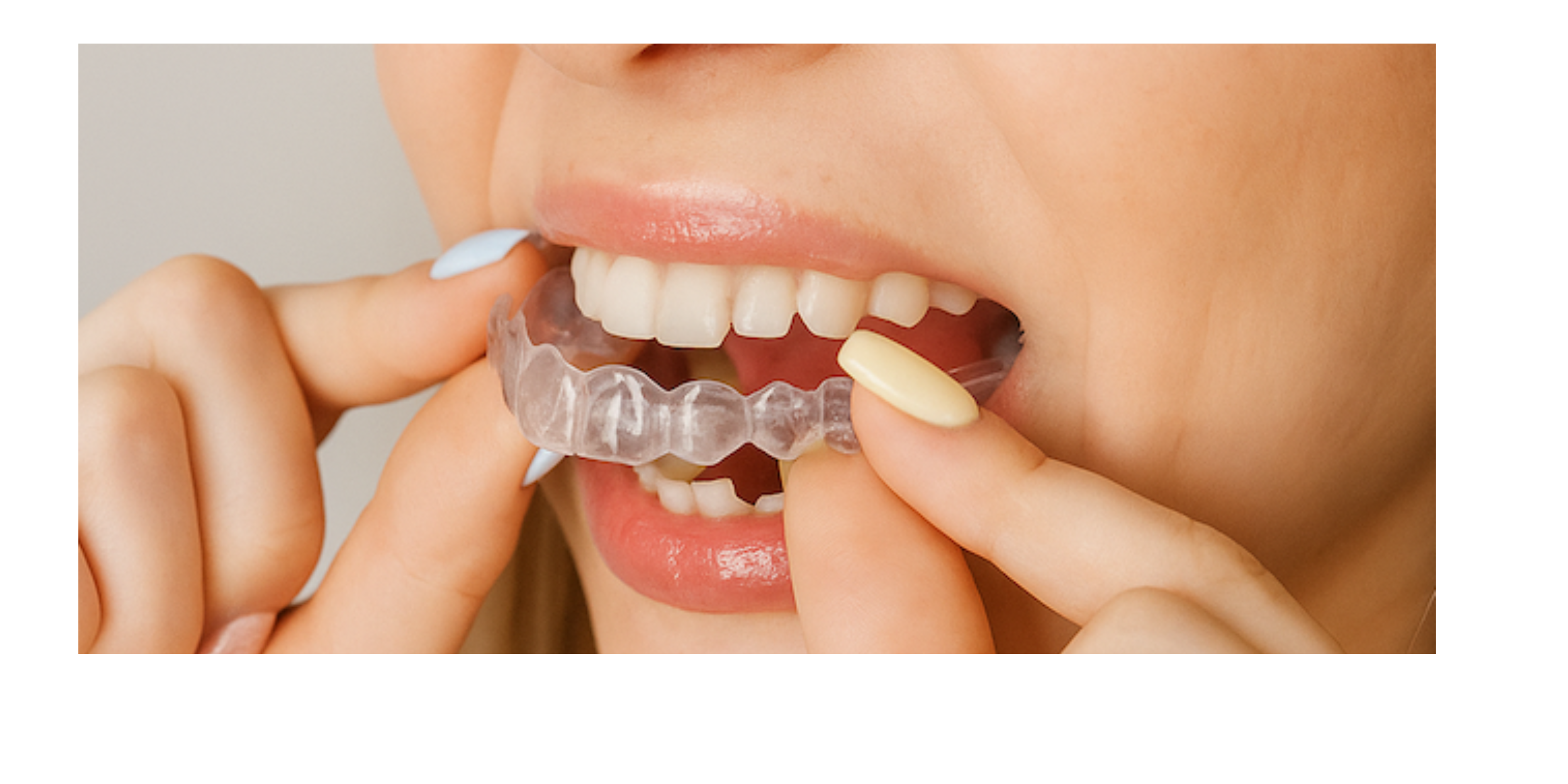 The Ultimate Guide to Hawley Retainers with Glitter: Keep Your Smile Perfect