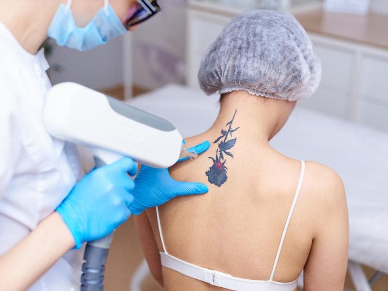 Affordable Tattoo Removal Options in Rohini Without Compromising Safety