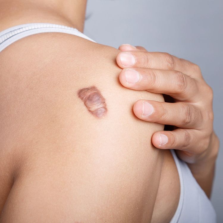 Can Skin Tags Spread?