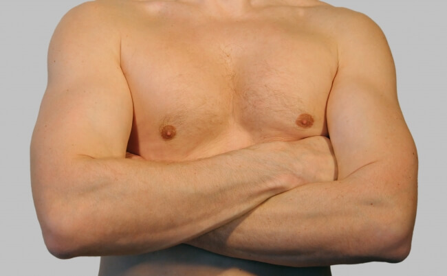Is Gynecomastia Surgery the Only Permanent Solution?