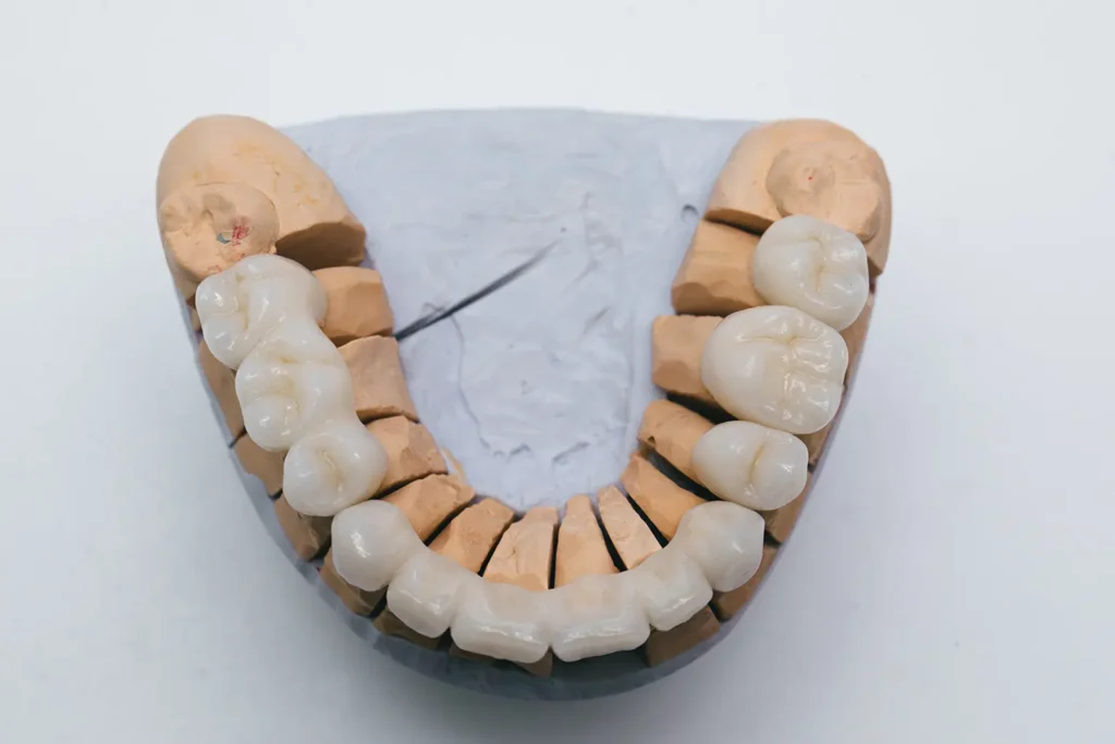 Oral Hygiene Tips for Long-Lasting Dental Crowns and Bridges