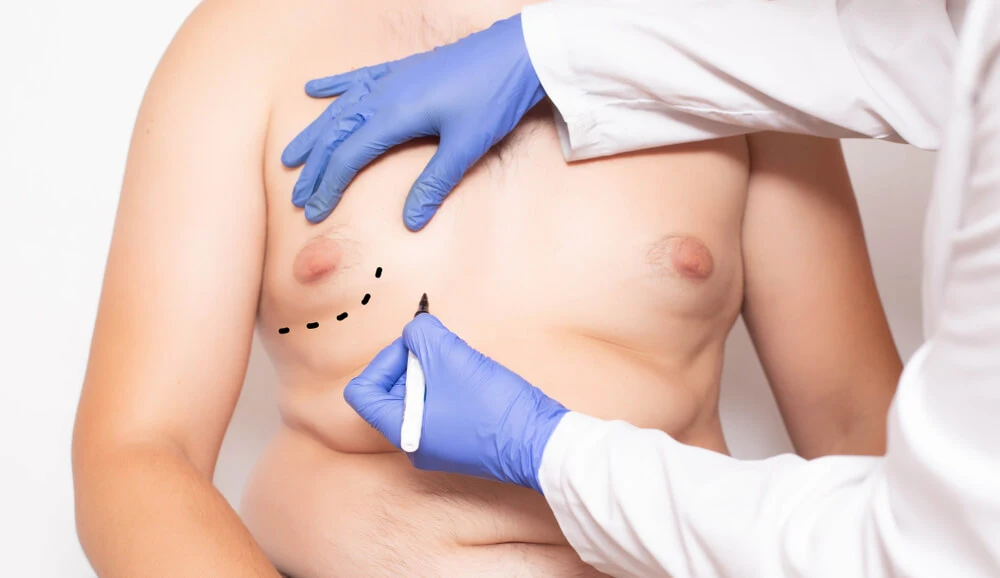 Gynecomastia and Body Image Issues in Men