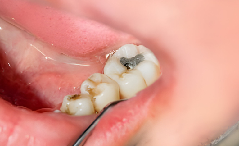 Tooth Filling Cost for Tooth Sensitivity Issues