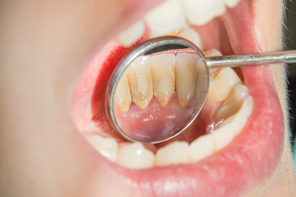 Can Teeth Cleaning Fix Bad Breath?
