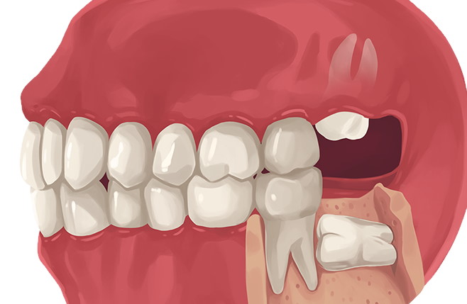 How to Mentally Prepare for Wisdom Tooth Extraction
