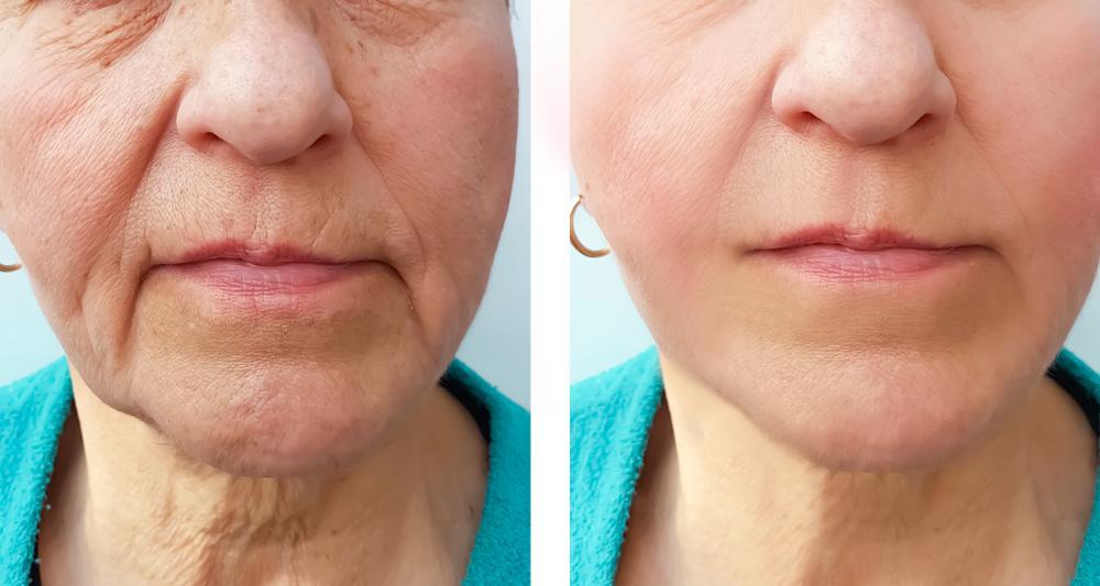Juvederm Fillers for Nasolabial Folds: What to Expect