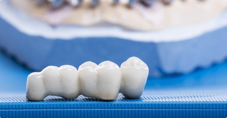 How Dental Crowns and Bridges Protect Weak Teeth