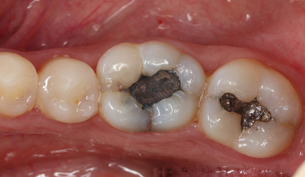 Eco-Friendly Dental Tooth Filling Options for a Healthier Smile