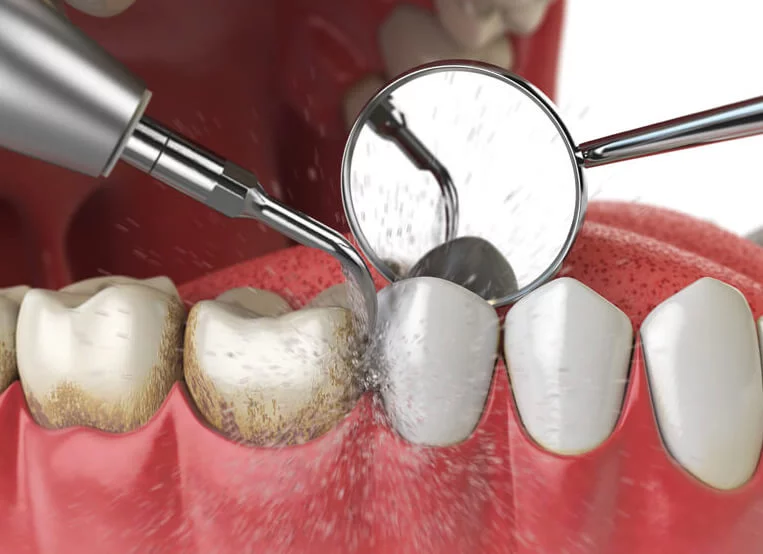 Teeth Cleaning Explained: From Plaque to Shine