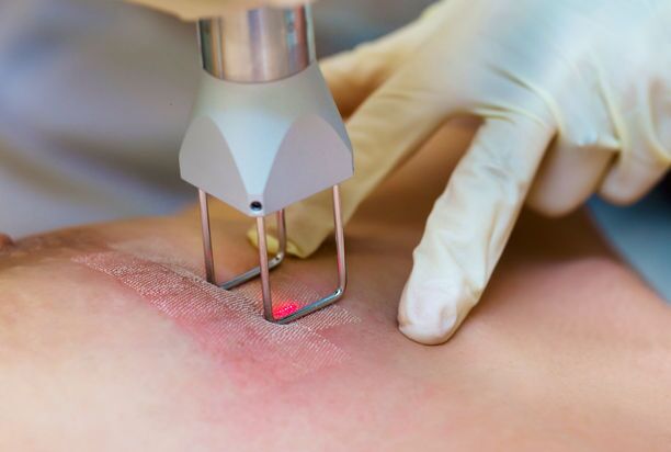 Laser Stretch Marks Treatment for Breast Stretch Marks