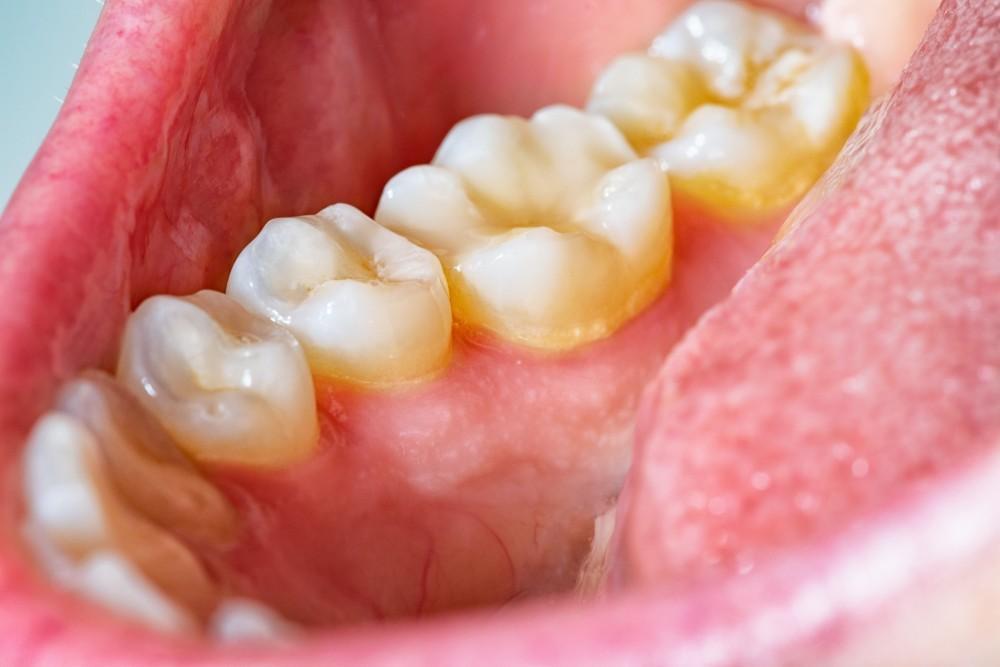 How Teeth Cleaning Reduces Plaque and Tartar