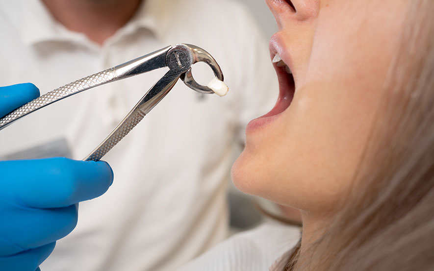 Tooth Extraction Cost for Broken or Damaged Teeth