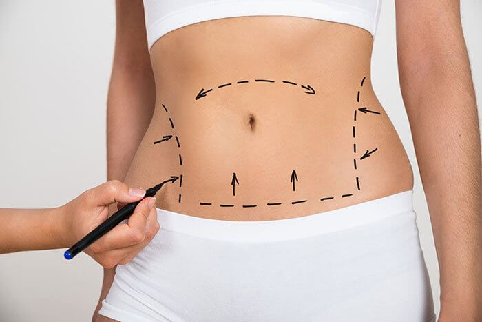 Water-Assisted Liposuction Explained