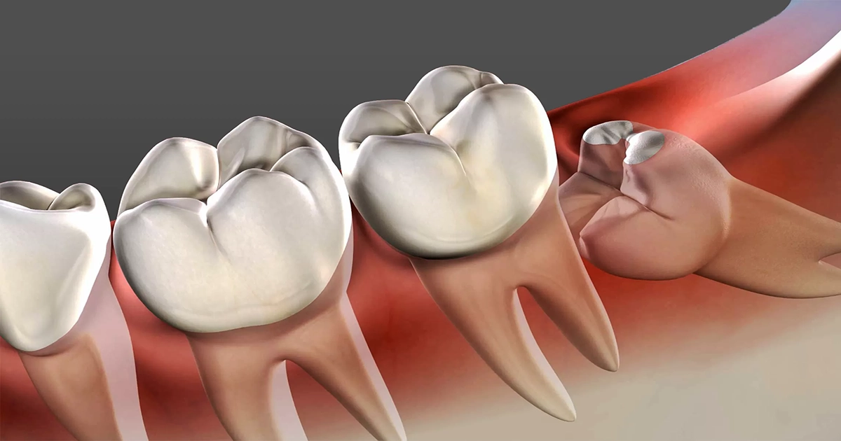 Wisdom Tooth Extraction: Common Reasons Dentists Recommend It