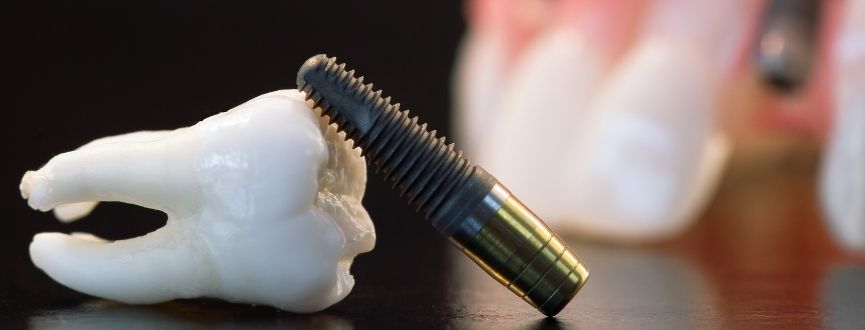 Dental Implant in Hinjewadi – A Permanent & Natural Solution for Missing Teeth
