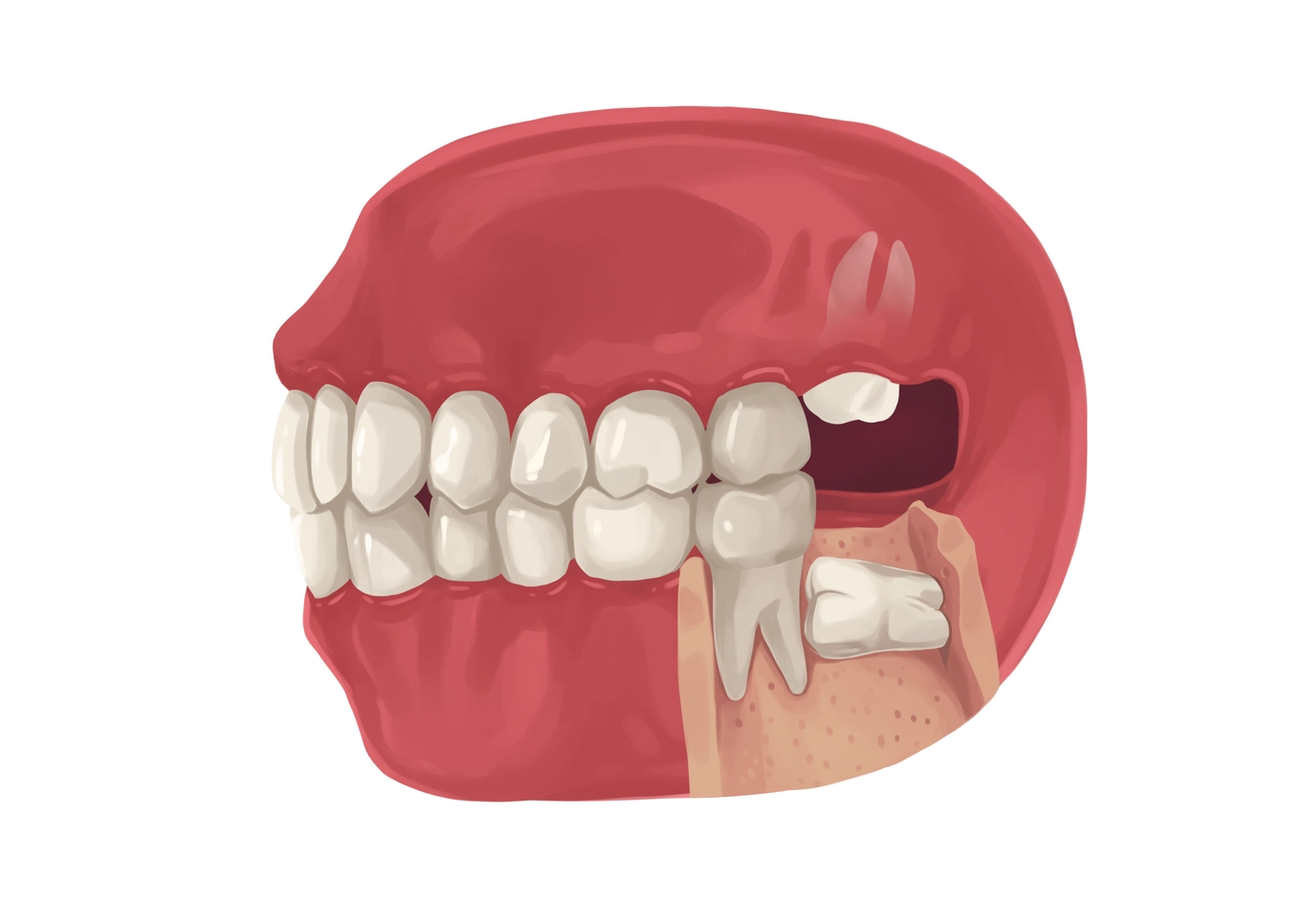 Is Wisdom Teeth Removal a Major Surgery?
