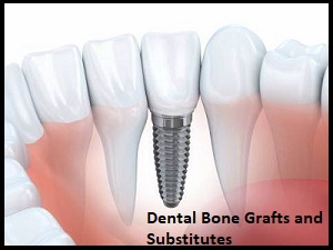Global Dental Bone Grafts and Substitutes Market Manufacturers Analysis Report 2020-2026