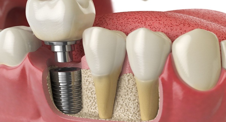 How Dental Implants Can Transform Your Smile