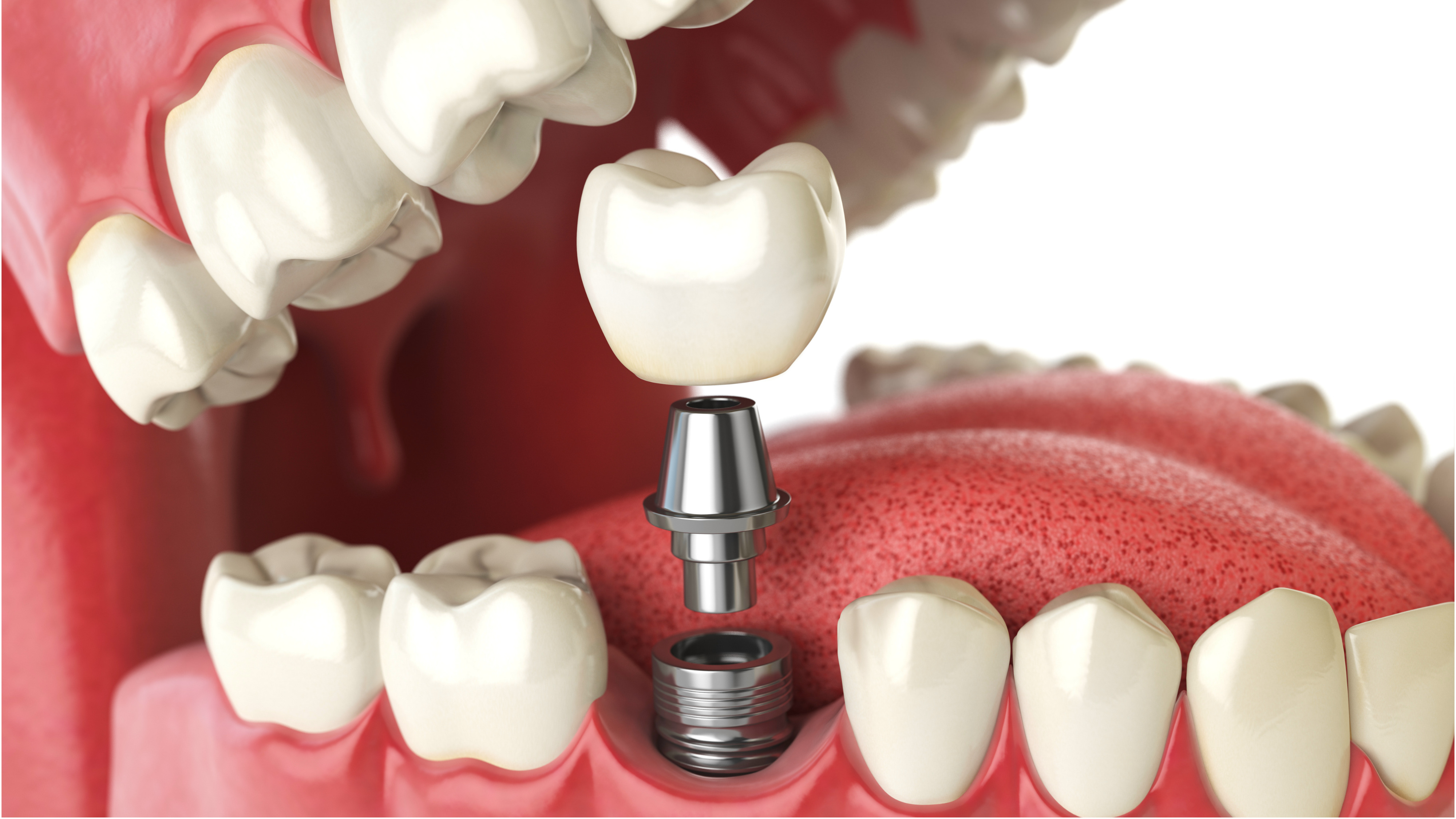 Dental Implants in Chennai | Permanent Tooth Replacement – Illume Advanced Dentistry