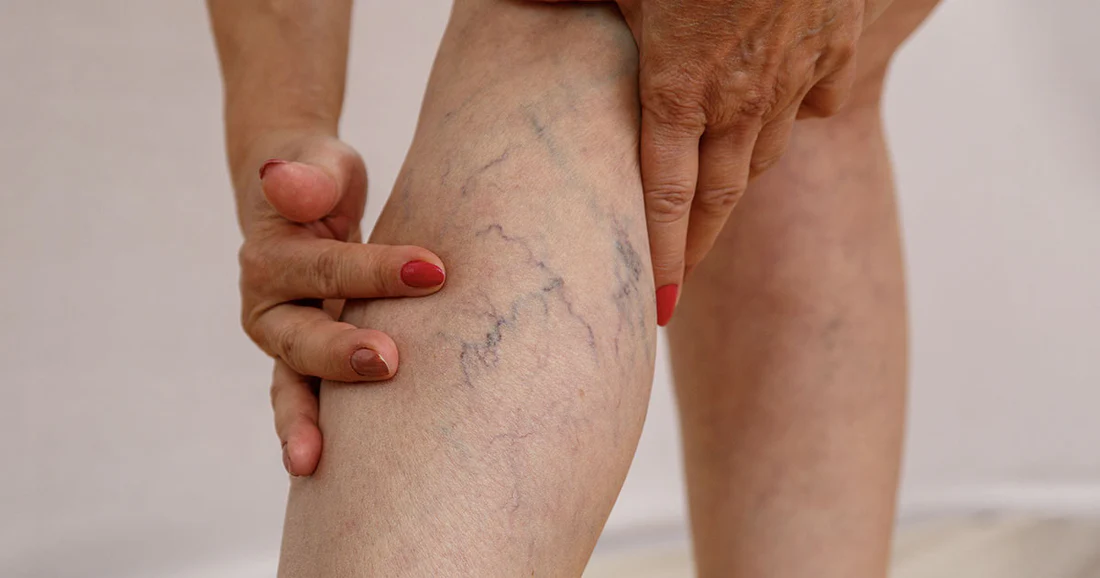 Varicose Veins Best Treatment in India: Expert Care by IRfacilities & Dr. Sandeep Sharma