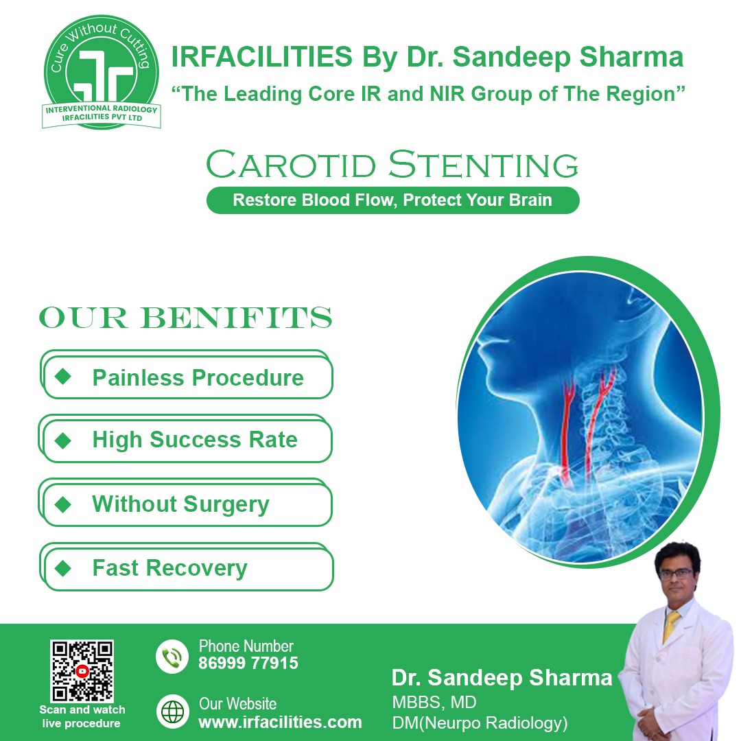Carotid Artery Stenting: Safe and Less Invasive Stroke Prevention Treatment