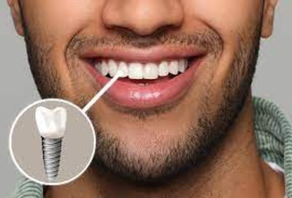 Where to Get Affordable Dental Implants in Dubai Without Sacrificing Quality