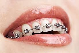 Niagara Falls Orthodontics: Advanced Braces & Invisalign by Dr. Falsafi