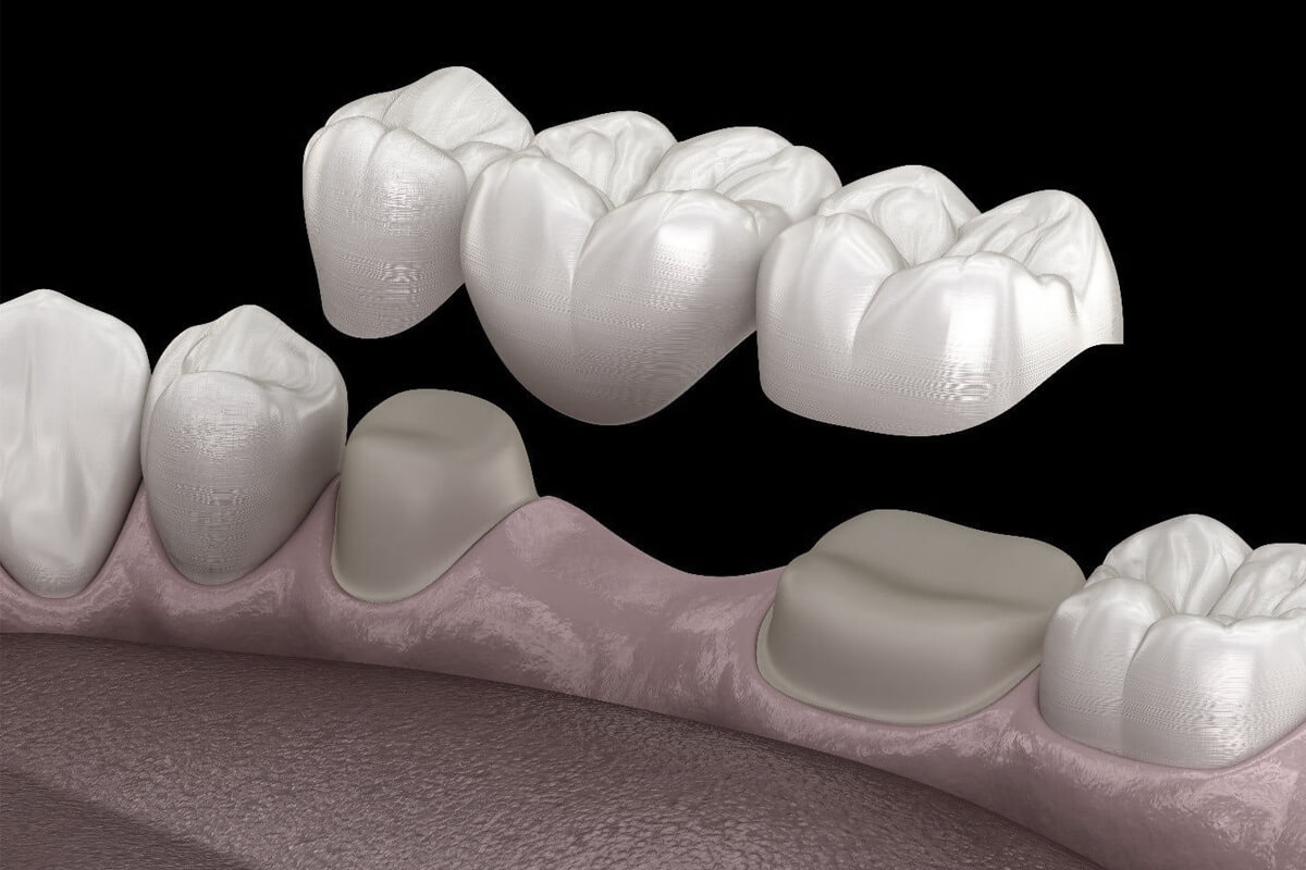 Comprehensive Guide to Dental Crowns and Bridges