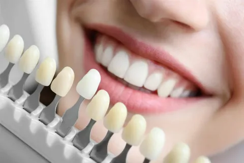 The Subtle Art of Smile Restoration: A Relatable Look at Dental Veneers