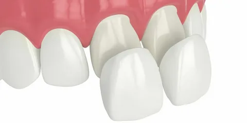 Everything You Need to Know About Dental Veneers