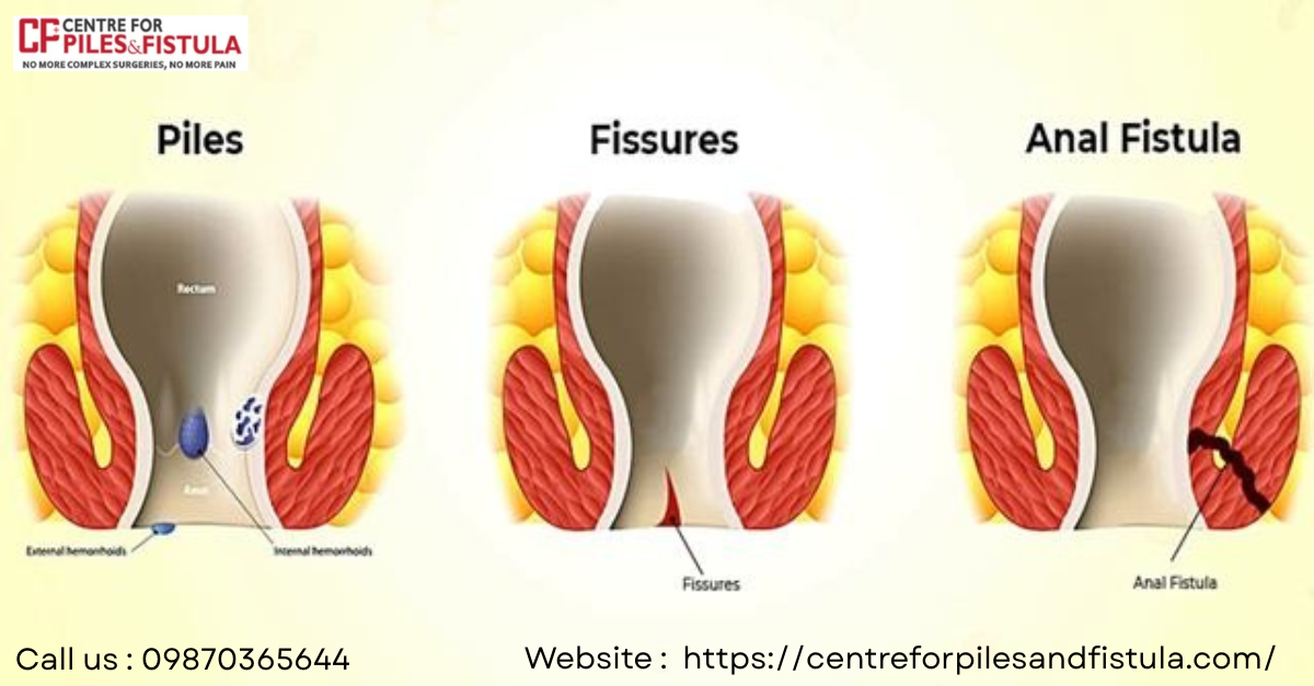 How to Find the Best Piles Doctor in Delhi for Safe Treatment  