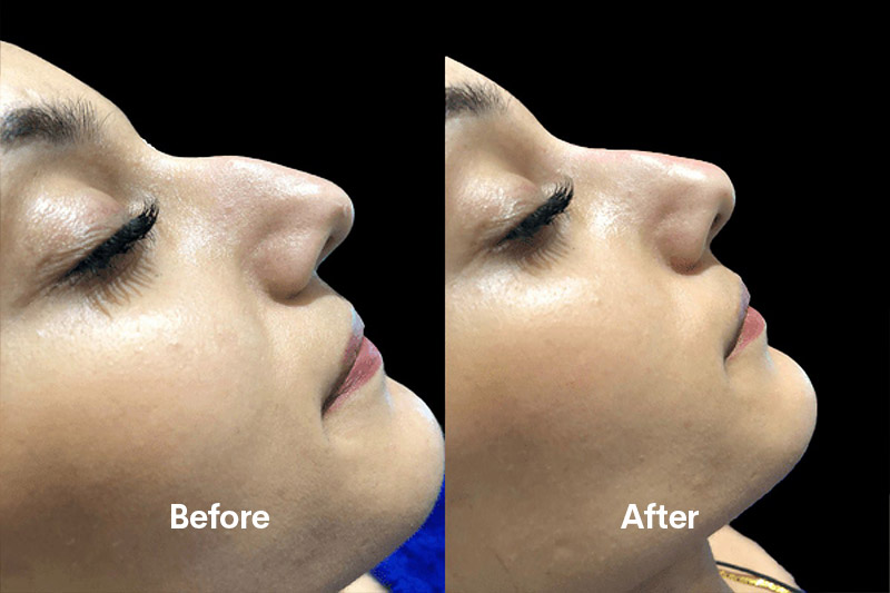 Rhinoplasty in Riyadh: Reshaping Your Confidence