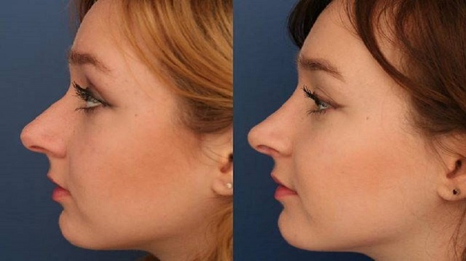 The Executive Edge: Why Riyadh’s Professionals Choose Refined Rhinoplasty