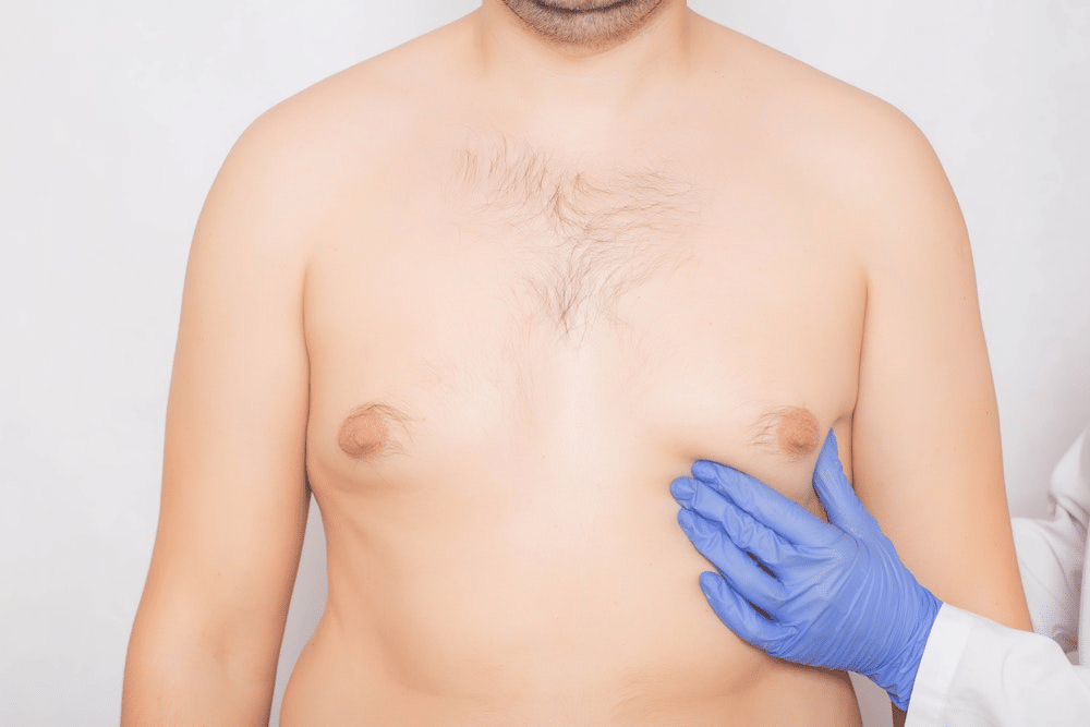 Minimally Invasive Gynecomastia In Islamabad