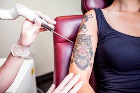 Pain Management During Tattoo Removal in Islamabad