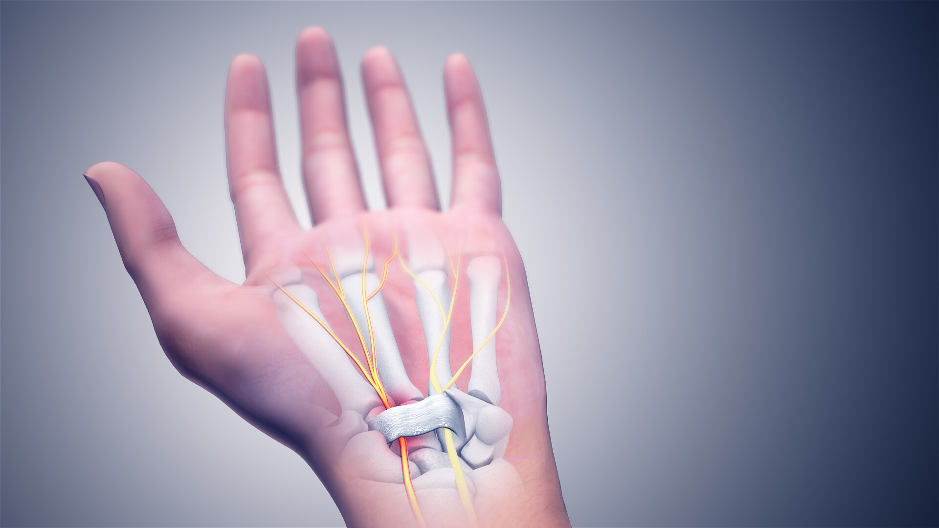 Carpal Tunnel Relief Without Surgery How to Get Comfort Back in Your Wrist