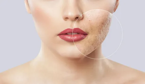 The Best Acne Scar Treatment for Sensitive Skin: A Practical Guide for Australians