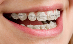 How Clear Braces for Adults Enhance Oral Health Through Proper Alignment