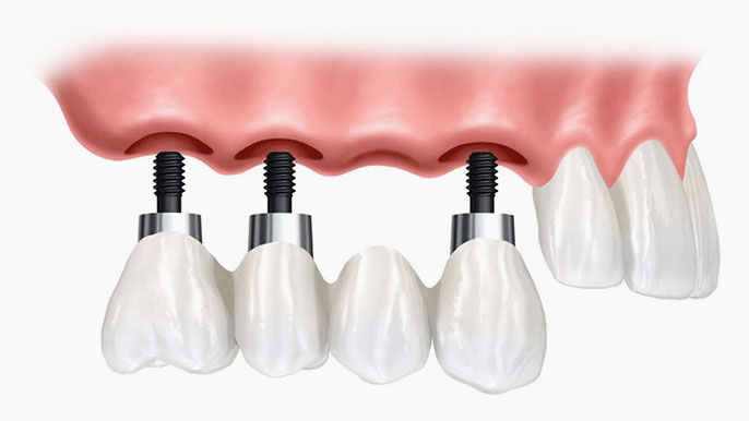 How are Dental Implants in Campbell Town Used?