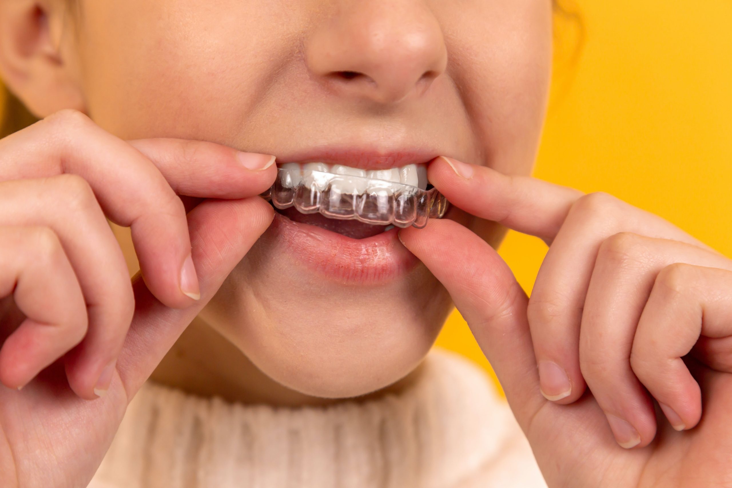 Teeth Aligners for Straighter Smiles: What Makes Them Effective?