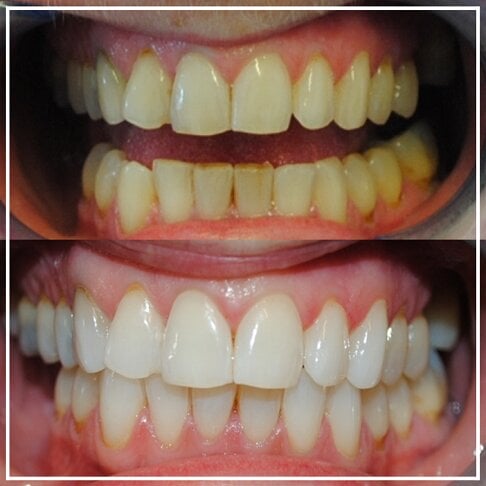 Teeth Whitening in Mitcham for a Bright Smile 
